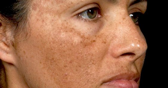 A imagem mostra o rosto de uma mulher que tem melasma